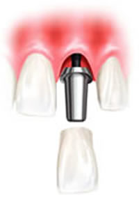 Dental Implant-Supported Dentures 