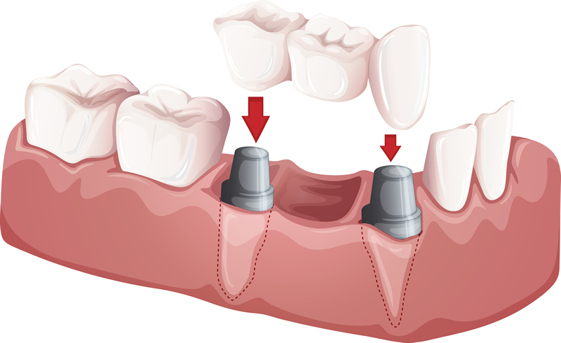 Dental Implants -Supported Crowns & Bridges