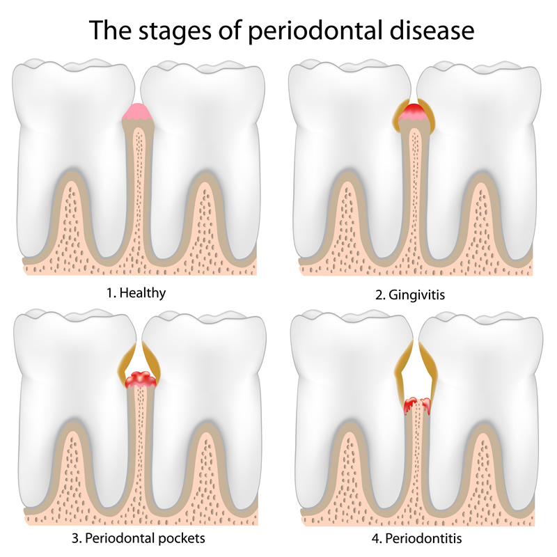 North York Dentist - Gum Disease Therapy - Stages of periodontal disease