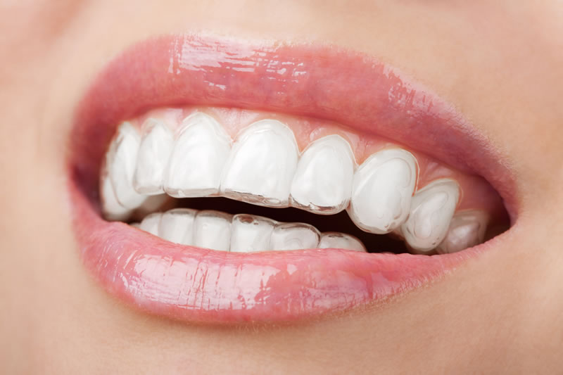 Orthodontics - Invisalign® clear aligners