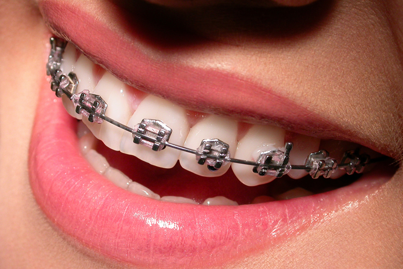 Traditional Braces Orthodontics - Traditional Braces image