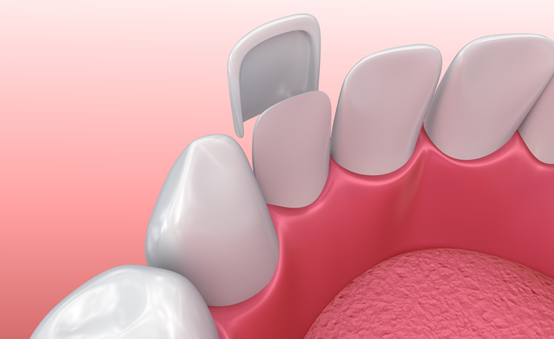 North York Dentist - Porcelain Veneers - Illustration