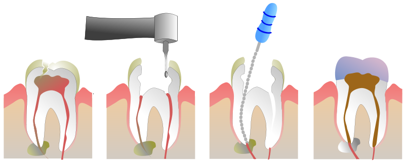 North York Dentist - Root Canal Therapy - Treatment Process