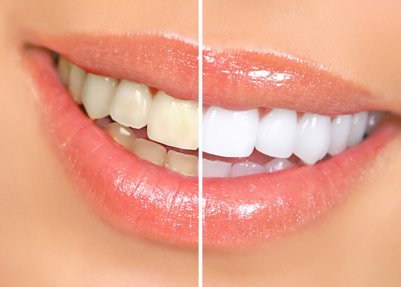 North York dentist - Teeth Whitening - before and after image