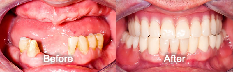 North York Dentist - Smile Gallery - Dentures