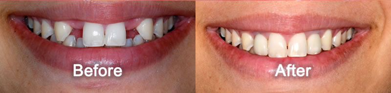 North York Dentist - Smile Gallery - Dental Implants