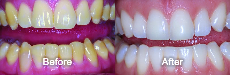 North York Dentist - Smile Gallery - Teeth Whitening