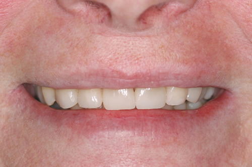 NorthYork Dentist - Full-Mouth Makeovers - After photo