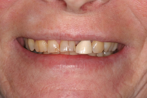 North York Dentist - Full-Mouth Makeovers - Before photo