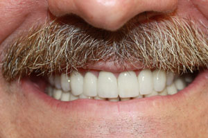 woodstock dentist full-mouth makeover-after