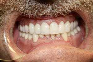 woodstock-dentist-full-mouth-makeover-before-300x199