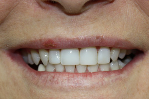 North York dentist-full-mouth-makeover-after3-300x199