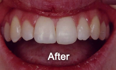 North York Dentist | Cosmetic Bonding | After