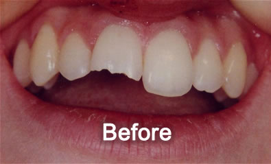 North York Dentist | Cosmetic Bonding | Before