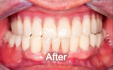 North York Dentist | Dentures | After