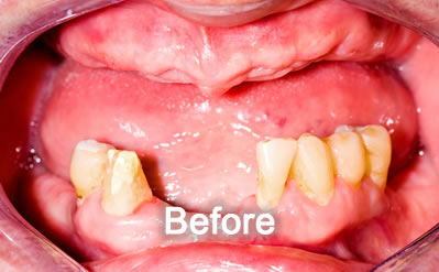 North York Dentist | Dentures| Before