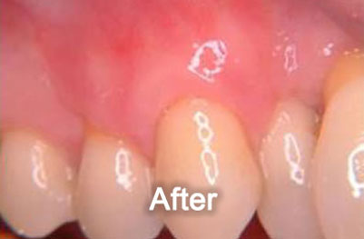 North York Dentist | Gum Grafting | After