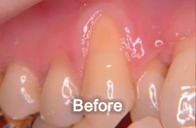 North York Dentist | Gum Grafting | Before