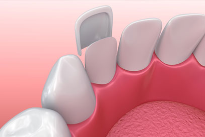 North York Dentist | Porcelain Veneers