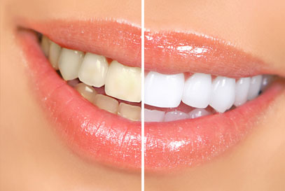 North-York-Dentist | Teeth Whitening