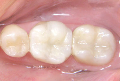 North-York-Dentist - White-Composite Filling | After