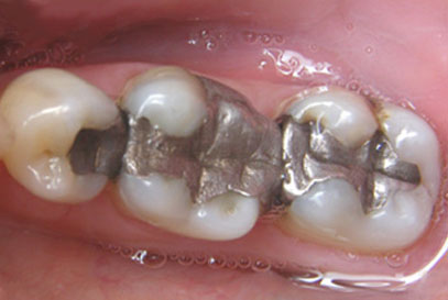 North-York-Dentist - White-Composite Filling | Before