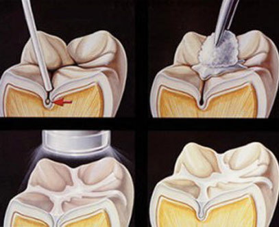 North York Dentist | Childrens Dentistry | Dental Sealants