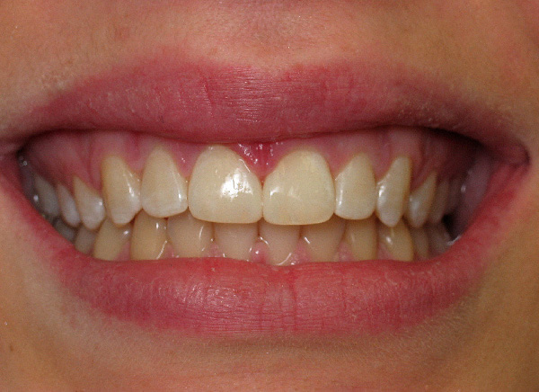 North-York-Dentist-cosmetic-bonding-after