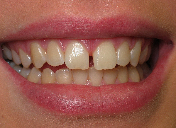 North-York-Dentist-cosmetic-bonding-before