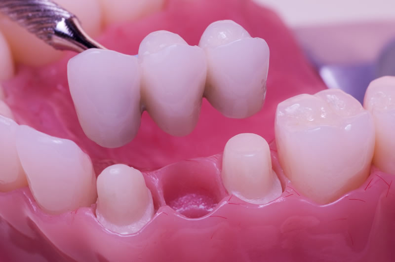 North York Dentist - Crowns-Bridges-Dentures - Bridges Restoration