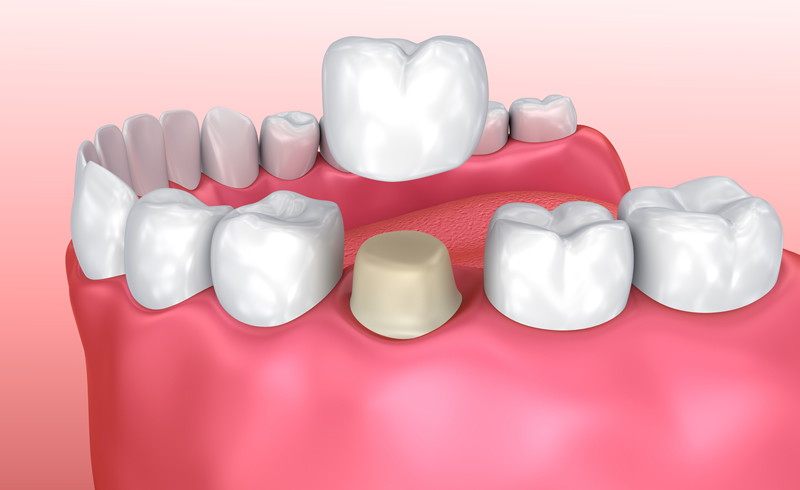 North York Dentist - Crowns-Bridges-Dentures - Crowns Restoration