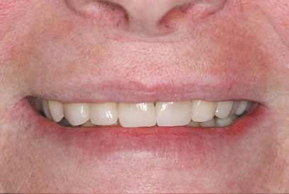 North York Dentist | Full-Mouth Makeover | After