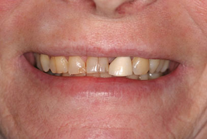 North York Dentist | Full-Mouth Makeover | Before