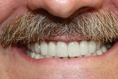 North York Dentist | Full-Mouth Makeover | After