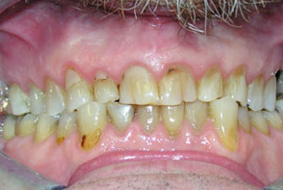 North York Dentist | Full-Mouth Makeover | Before