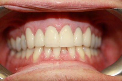 North York Dentist | Full-Mouth Makeover | After