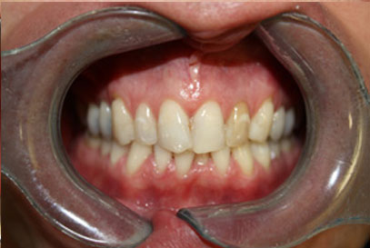 North York Dentist | Full-Mouth Makeover | Before