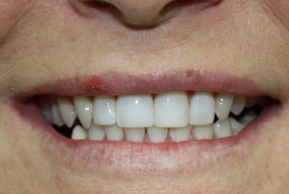 North York Dentist | Full-Mouth Makeover | After