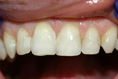 North York Dentist | Full-Mouth Makeover | Before