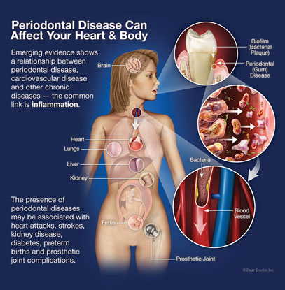 North York Dentist-Gum Disease Therapy
