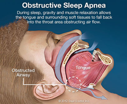 North York Dentist | Obstructive Sleep Apnea