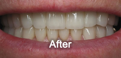 North York Dentist | Porcelain Veneers | After