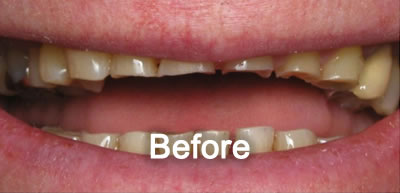 North York Dentist | Porcelain Veneers | Before