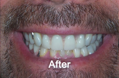 North York Dentist | Smile Makeover | After