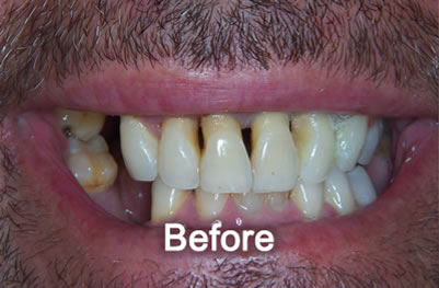North York Dentist | Smile Makeover | Before