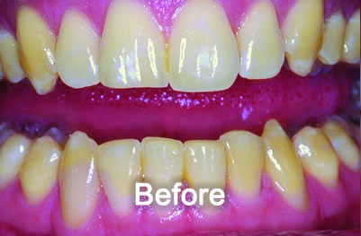 North York Dentist | Teeth Whitening | Before