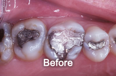 North York Dentist | White-Fillings | Before