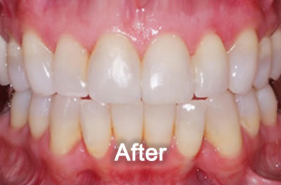 North York Dentist | Invisalign | After