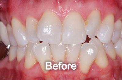 North York Dentist | Invisalign | Before