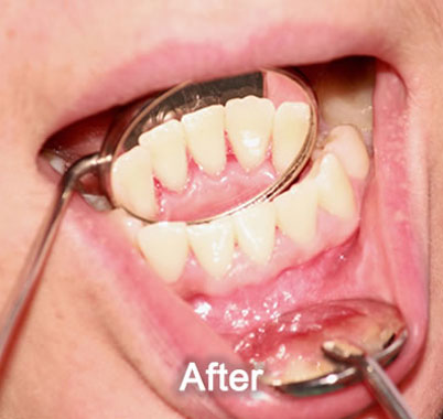 North York Dentist | Dental Cleaning | After